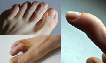 Çekiç Parmak Nasıl Tedavi Edilir?