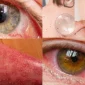 Dermatoloji İle Cilt Rahatsızlıklarına Son